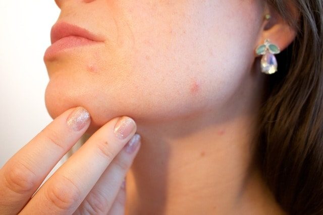 The Ultimate Guide to Moisturisers for Acne-Prone Skin