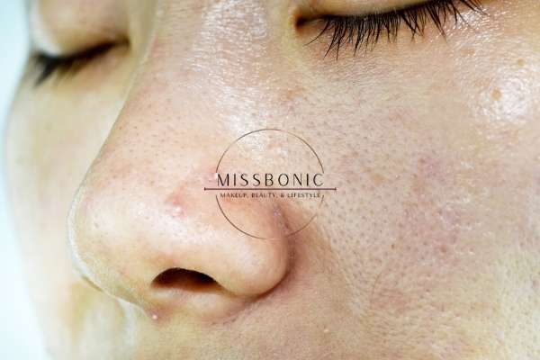 Large Pores  12 Trusted Home Remedies